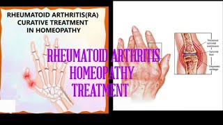 Rheumatoid Arthritis - Homeopathy Treatment #jointpain #pain #arthritis #youtube #medicine