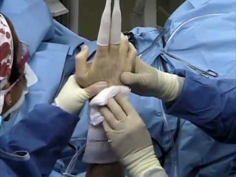 Artroskopia nadgarstka - naprawa uszkodzonej chrząstki