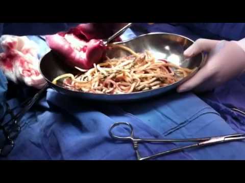 Come distinguere dysbacteriosis da vermi Bere targhe a vermi