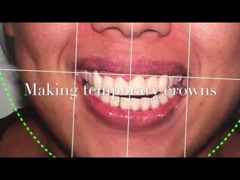 Treatment of Gummy Smile during and after orthodontics