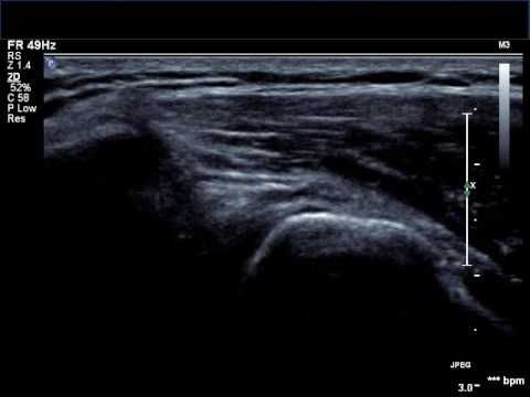Artroza articulațiilor inferioare ale piciorului
