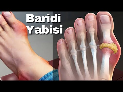 , title : 'Baridi Yabisi - Homa ya Viungo (Rheumatoid Arthritis) na Gauti (Gout) | Na Prof. Mtango'