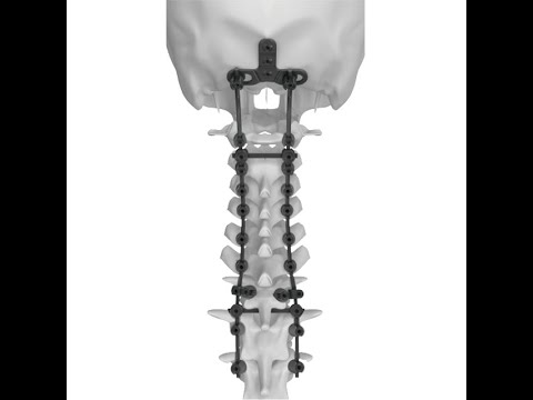 Trauhui spine posterior fixation system--Ceres 3 5