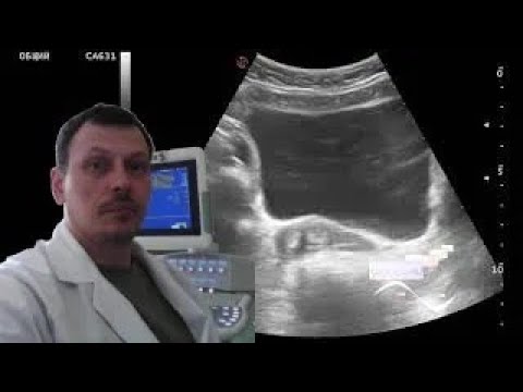 Pediatric Kidney & Female pelvic ultrasound - One kidney two uteri