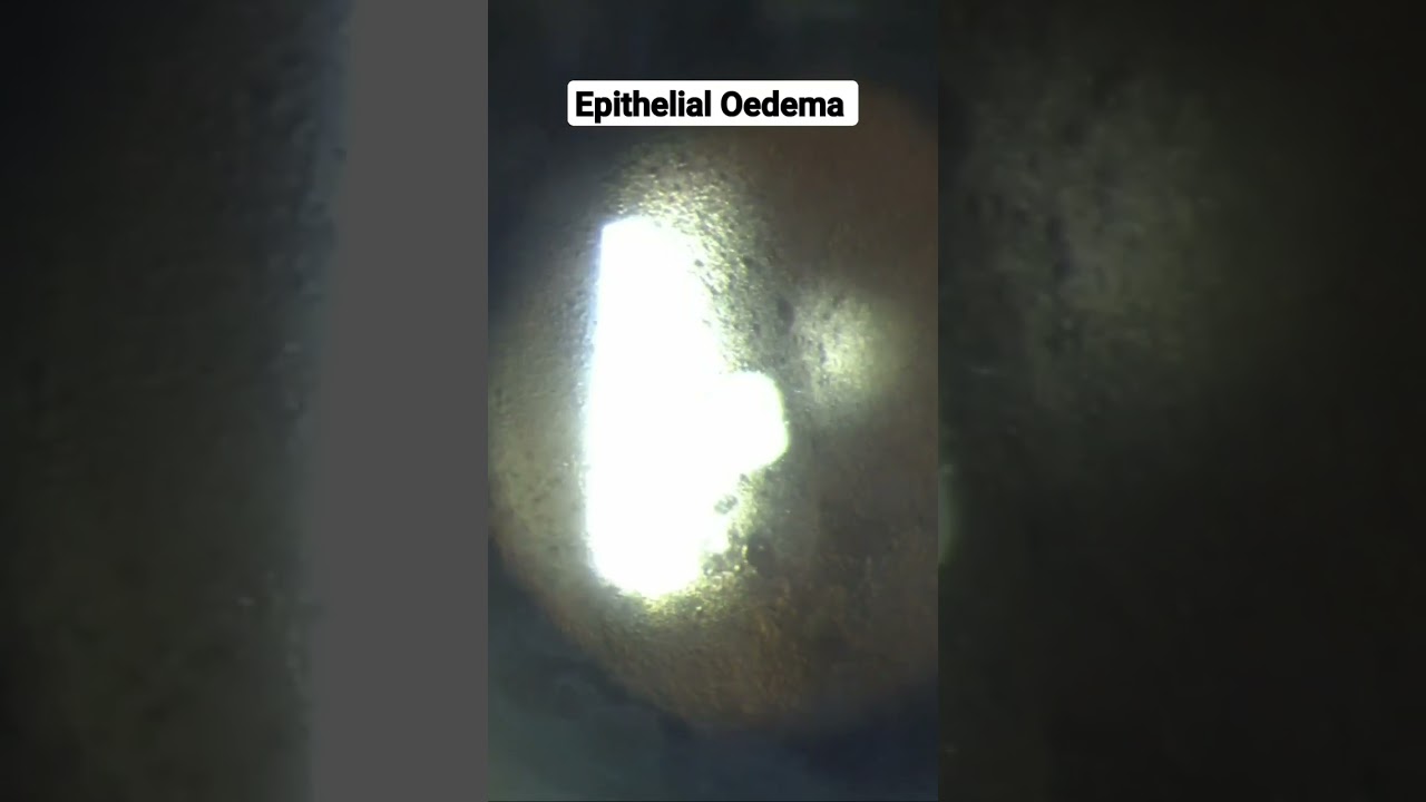 epithelial oedema