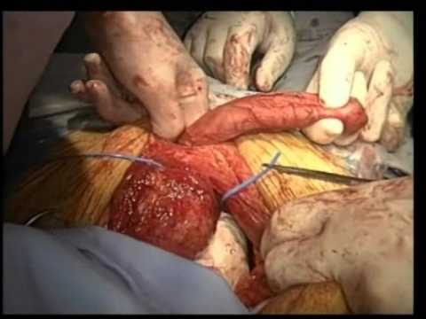 Radical Cystoprostatectomy - Prophylactic Prepubic Urethrectomy