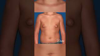 Tuberous Gynecomastia with Puffy Nipple Removal for a tighter more masculine and defined chest