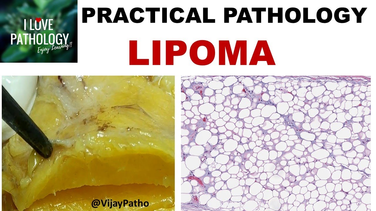 LIPOMA : Gross & Microscopy, Types and variants