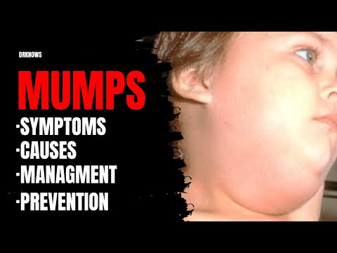 Mumps Symptoms, Causes, Management, Prevention, Complications