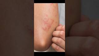 Home remedies for fungal infections || #viral #shortvideo #fungalinfections #Fungal