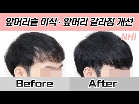 [탈모치료][모발이식] 남자앞머리숱이식 앞머리갈라짐 개선 360일 경과 I 뉴헤어 I Before&Afterㅣ헤어라인 모발이식