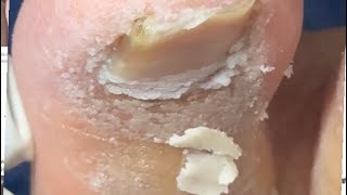 Ep_8744 Ingrown toenail removal 👣 เล็บจิก 😅 (clip from Thailand)