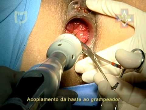 , title : 'Cirurgia Minimamente Invasiva para Hemorróidas - Anopexia Grampeada'