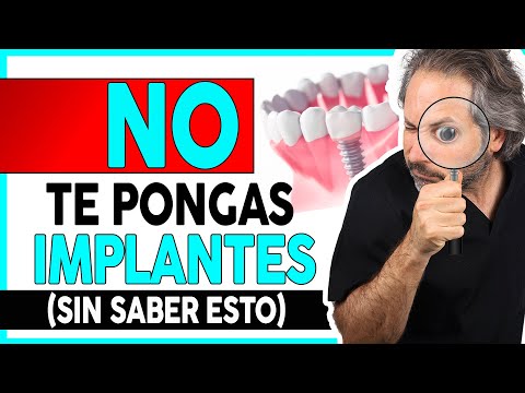 👉¿Que 𝗗𝗘𝗕𝗢 𝗦𝗔𝗕𝗘𝗥 del proceso de colocación de 𝗜𝗠𝗣𝗟𝗔𝗡𝗧𝗘𝗦 𝗗𝗘𝗡𝗧𝗔𝗟𝗘𝗦 para elegir a el DENTISTA ADECUADO?