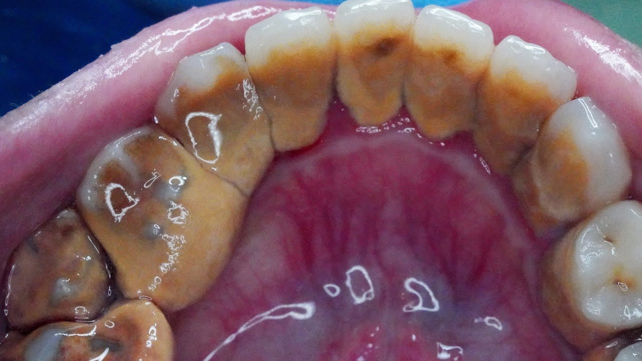 치석제거 쾌감쩌는 영상 썸네일