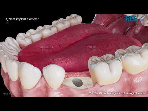 Volution - 3D Surgical Protocol