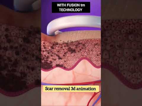 Scar removal treatment 3d animation with laser technique #shorts #medical #humanbody