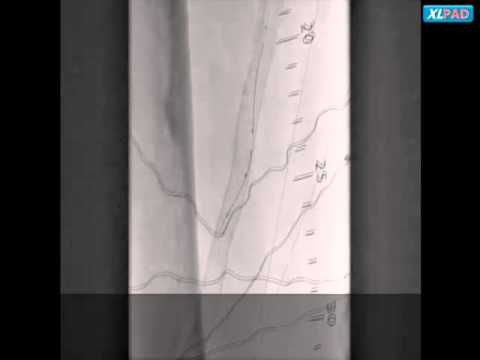 TruePath to Cross Right SFA CTO In-Stent Restenosis