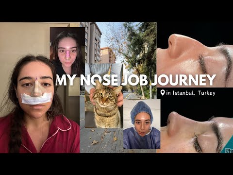 i got a rhinoplasty in TURKEY & documented the whole journey *nose job vlog*
