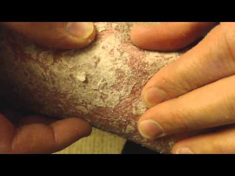 Man kann die Samen bei der Schuppenflechte essen Propolis bei die Behandlung der Schuppenflechte