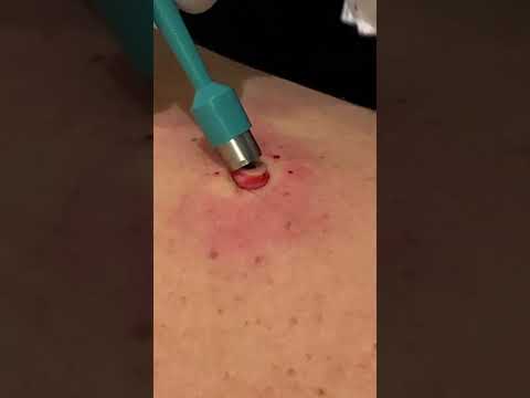 QUICK BACK POP |  PT 1  #pimplepopper #thedoc #cyst #blackheads #satisfying
