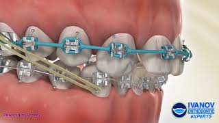 Canine Substitution for Lateral Incisor