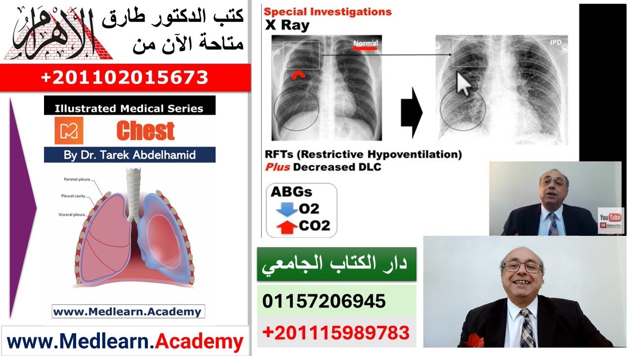 Interstitial Lung Disease (IPD)  #cme #internal_medicine #medical #usmle #محاضرات_باطنة