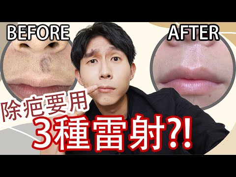 原來醫美雷射那麼多種？車禍疤痕如何處理！真實心得分享