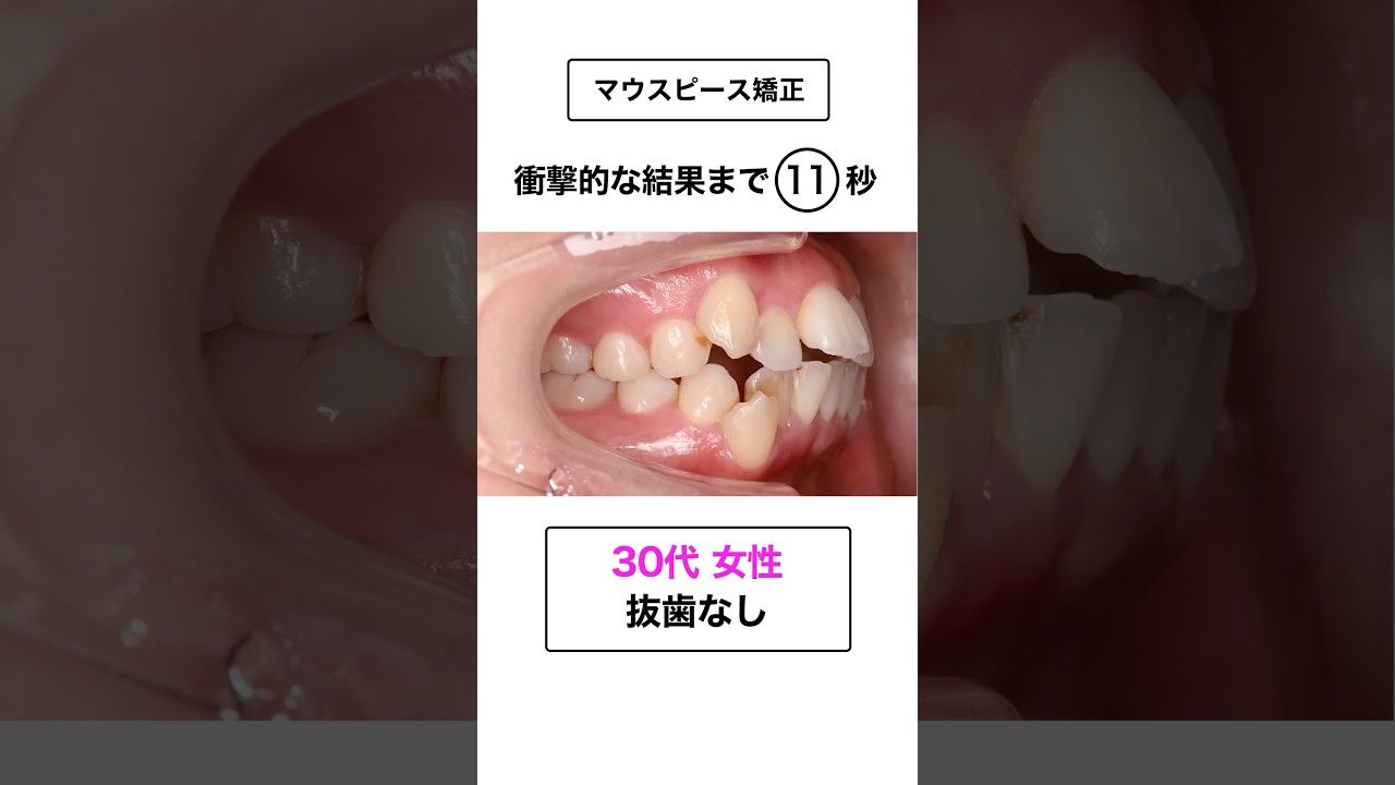 ワイヤーではなくマウスピース矯正したい方必見！#インビザライン #歯列矯正 #さいとう矯正歯科