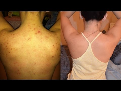 download lagu mp3 mp4 Lemon Sugar Scrub For Bacne, download lagu Lemon Sugar Scrub For Bacne gratis, unduh video klip Lemon Sugar Scrub For Bacne