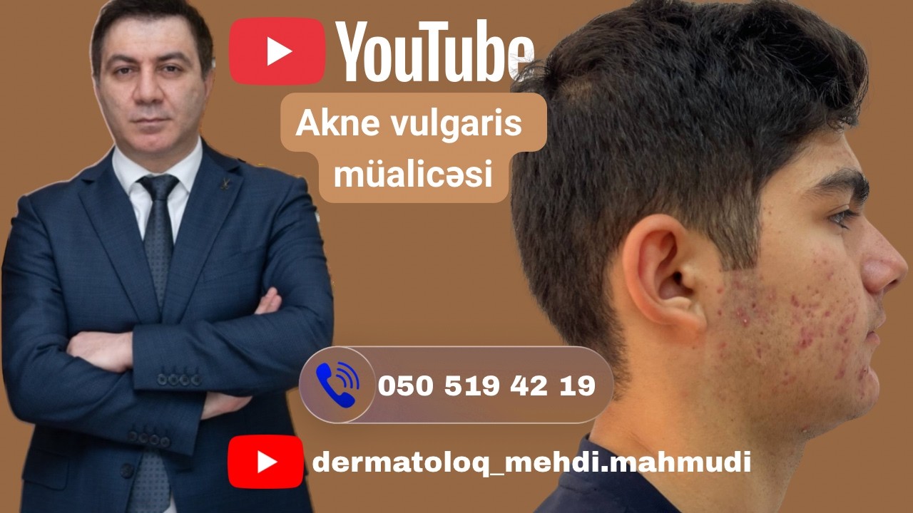 Akne Vulgaris Xəstəliyi