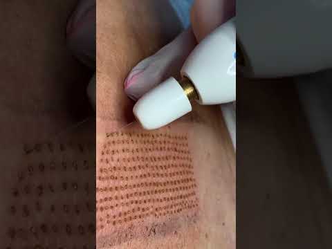 Fibroblast Plasma Skin Tightening at High Grade House