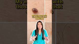 Have you tried to remove a skin tag yourself and how did it work out for you?⁠