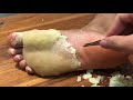#skin75 hand and foot skin peeling