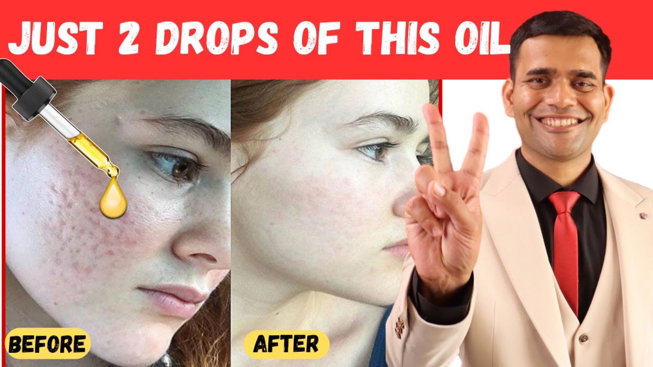 Just 2 drops of this magical oil to Get Rid of Acne Scars - Dr. Vivek Joshi