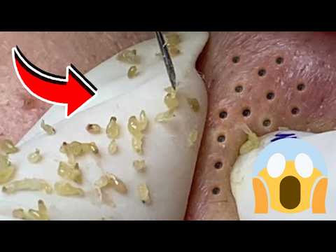 EXTRAÇÃO DE CRAVOS SATISFATÓRIA | LIMPEZA DE PELE COMENTADA POR ESTETICISTA! #356423