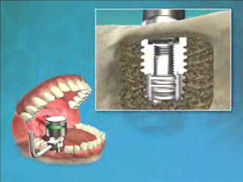 DENTACK DENTAL IMPLANTS