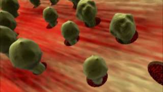 Aplastic AnemiaVideo In India Aplastic AnemiaVideo In India