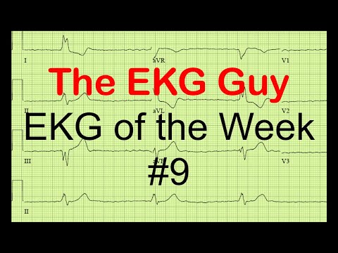 EKG/ECG of the Week #9 | The EKG Guy - www.ekg.md