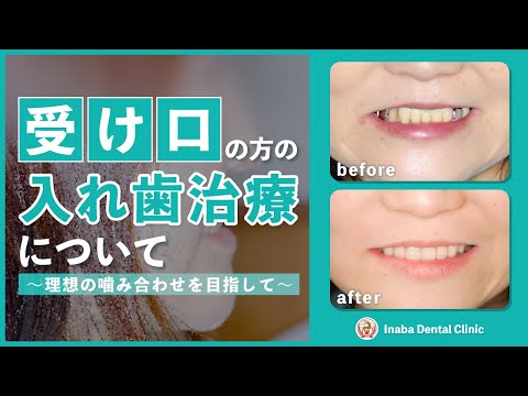 受け口の方の入れ歯治療について 〜理想の噛み合わせを目指して〜
