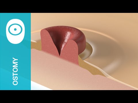 Brava® Moldable Ring