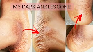 HOW TO GET RID OF DARK ANKLES.how to remove dark ankles,get rid of dark ankles#clearskin #skincare