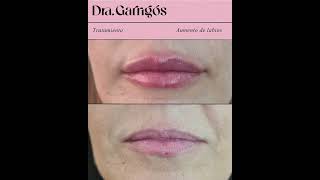 Antes y después Voluminización de labios  - Eva Garrigós Gracia