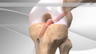 ACL ReconstructionVideo In India ACL ReconstructionVideo In India