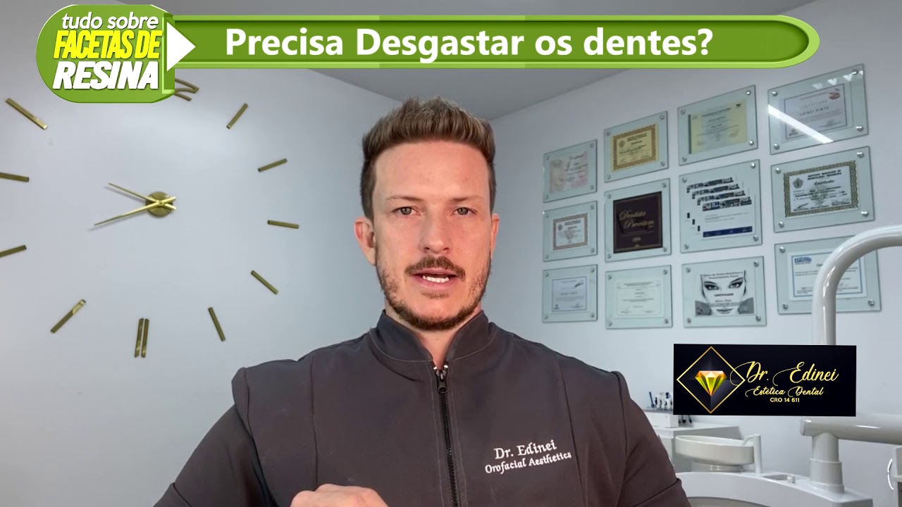Watch Now Facetas de Resina - Desgasta os dentes Facetas de Resina - Desgasta os dentes