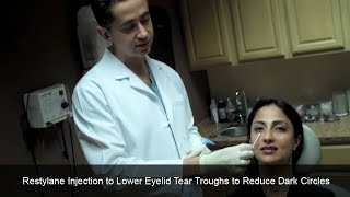 Restylane Injection to Lower Eyelid Tear Troughs to Reduce Dark Circles Chevy Chase Maryland