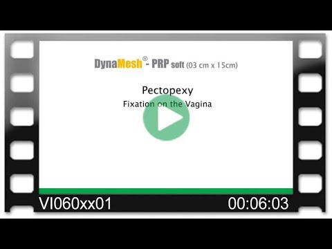 DynaMesh®-PRP visible 03 cm x 15 cm - OR Video: Pectopexy – Fixation on the Vagina