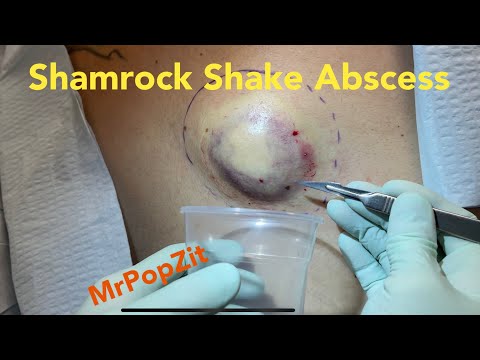 Shamrock shake giant abscess on back. Incision and drainage. Contents collected in cup. MrPopZit.