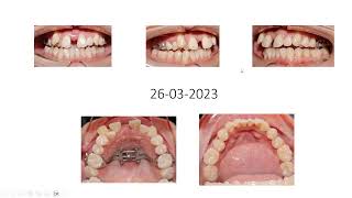 Case hạng 1 chen chúc, cắn chéo với MSE