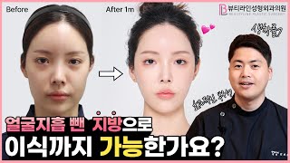 얼굴지방흡입하고 뺀 지방으로 지방이식까지?ㅣ 몸지방흡입 부위에 따라 지방 생착률차이가 있나요?